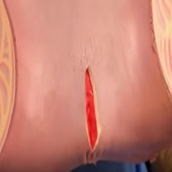 Internal anal fissure