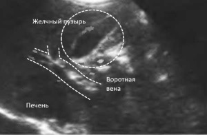 Ultrasound of the liver