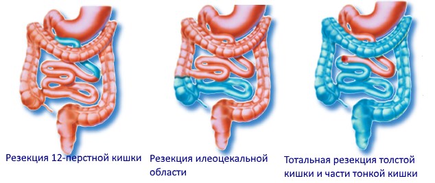 Bowel resection